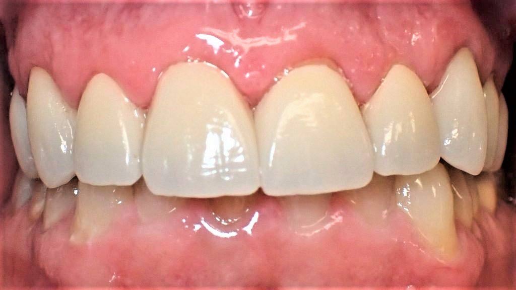 image of Full Mouth After