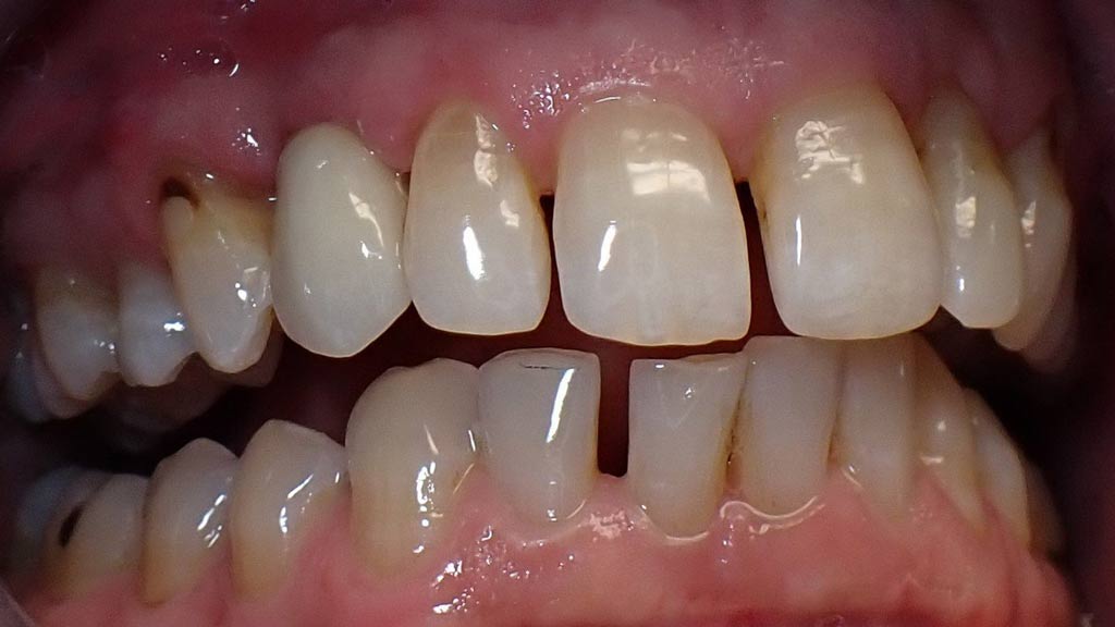 image of Implant After