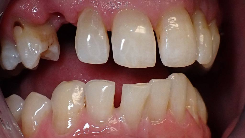 image of Implant Before