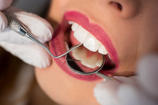 Woman with white teeth getting a dental cleaning at Cascade Dental in Medford, OR