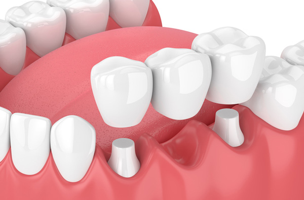 Rendering of jaw with dental bridge at Cascade Dental in Medford, OR