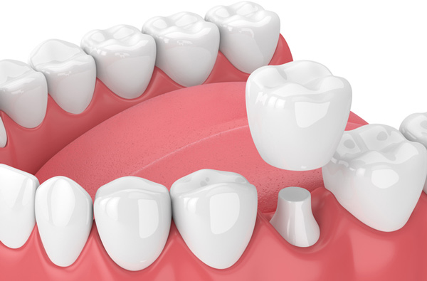 Rendering of jaw with dental crown at Cascade Dental in Medford, OR