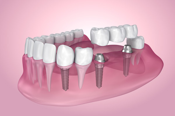 3D rendering of mouth with multiple dental implants at Cascade Dental in Medford, OR