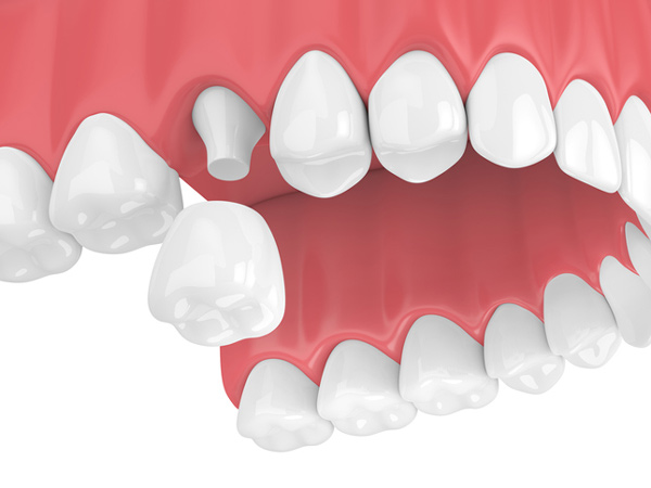 Rendering of jaw with dental crown at Cascade Dental in Medford, OR