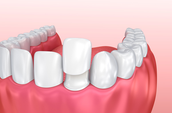 Rendering of jaw with porcelain veneer on tooth at Cascade Dental in Medford, OR