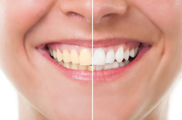 Before and after photo of teeth whitening treatment at Cascade Dental in Medford, OR